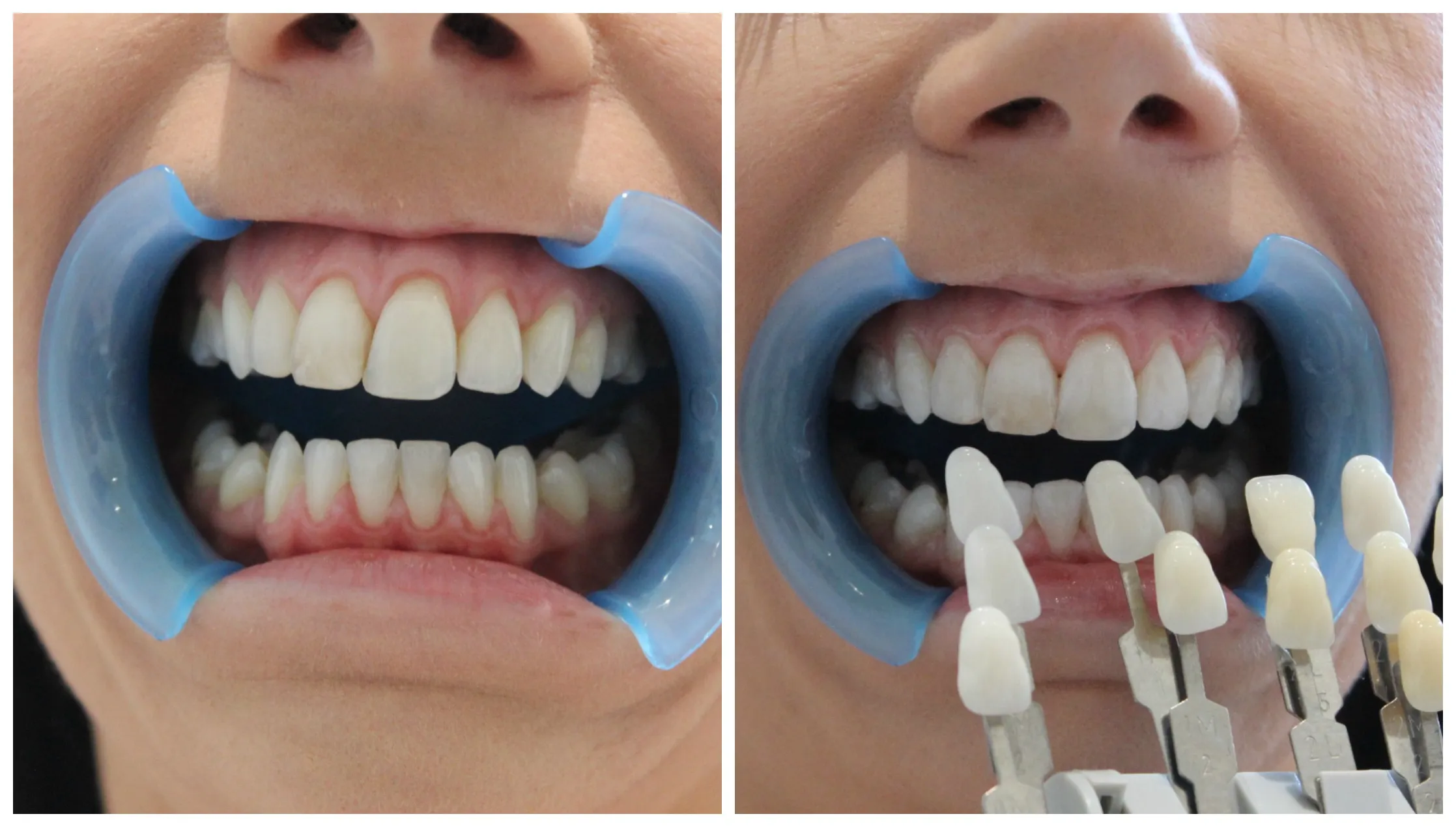 30370 laser whitening treatment teeth 4