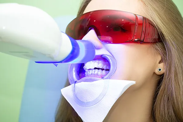 30370 laser whitening treatment teeth 6