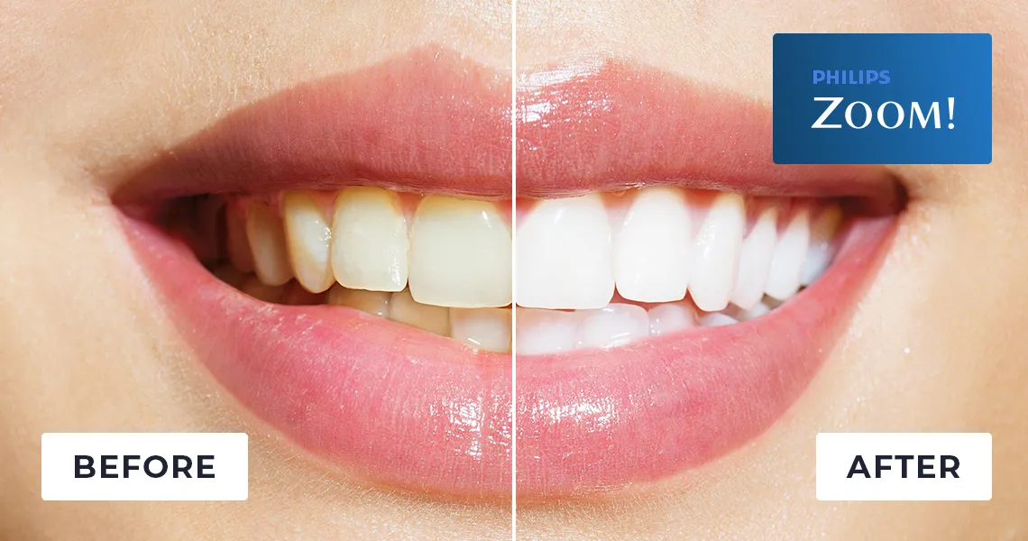 30371 aprilis teeth whitening gel