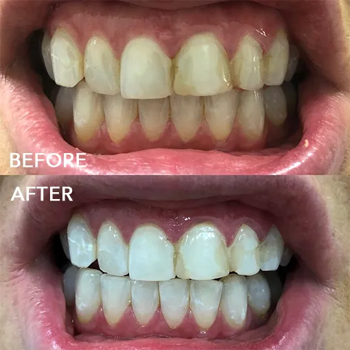 30371 aprilis teeth whitening process