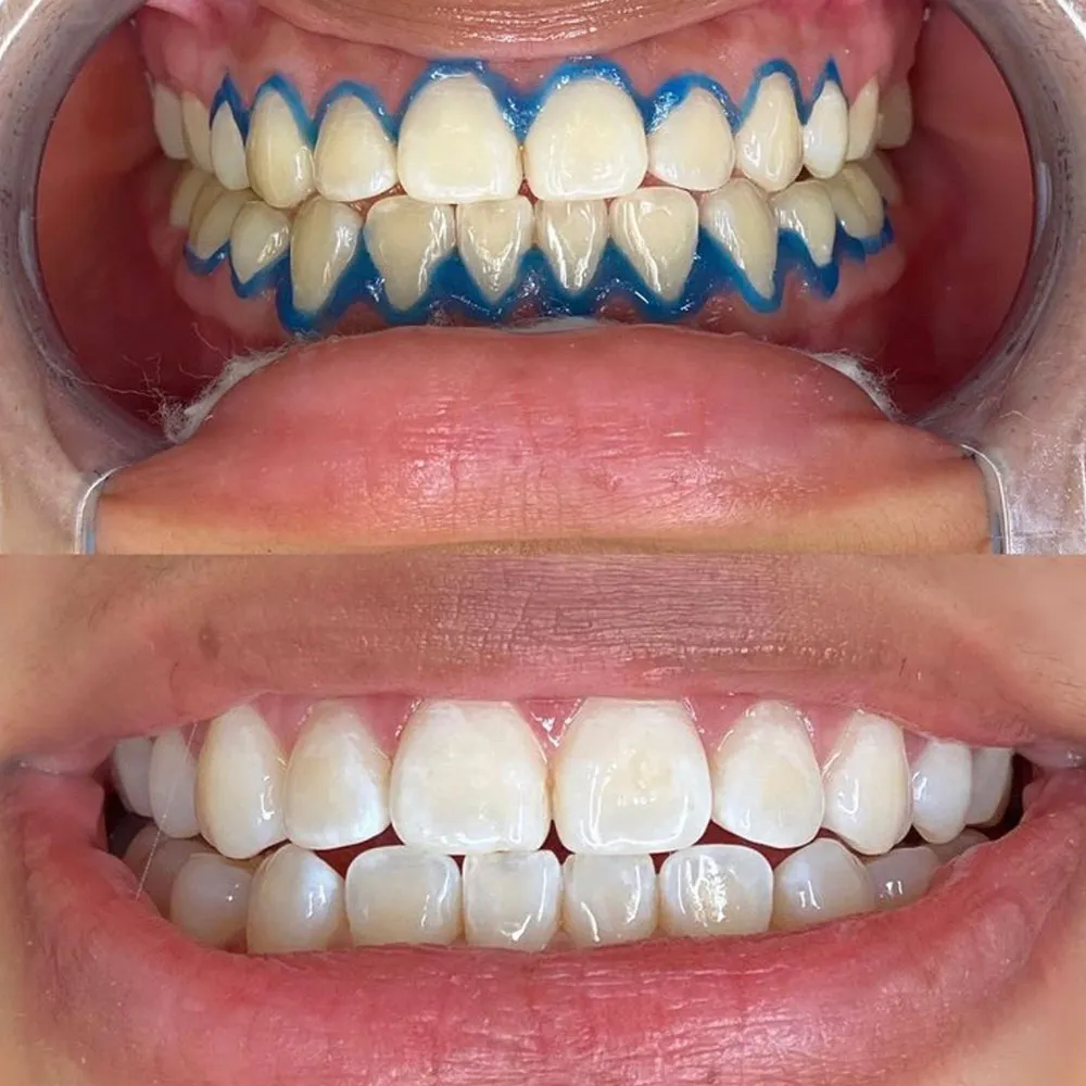 /img/30371-teeth-whitening-comparison.webp