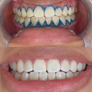 /img/30371-teeth-whitening-comparison.webp