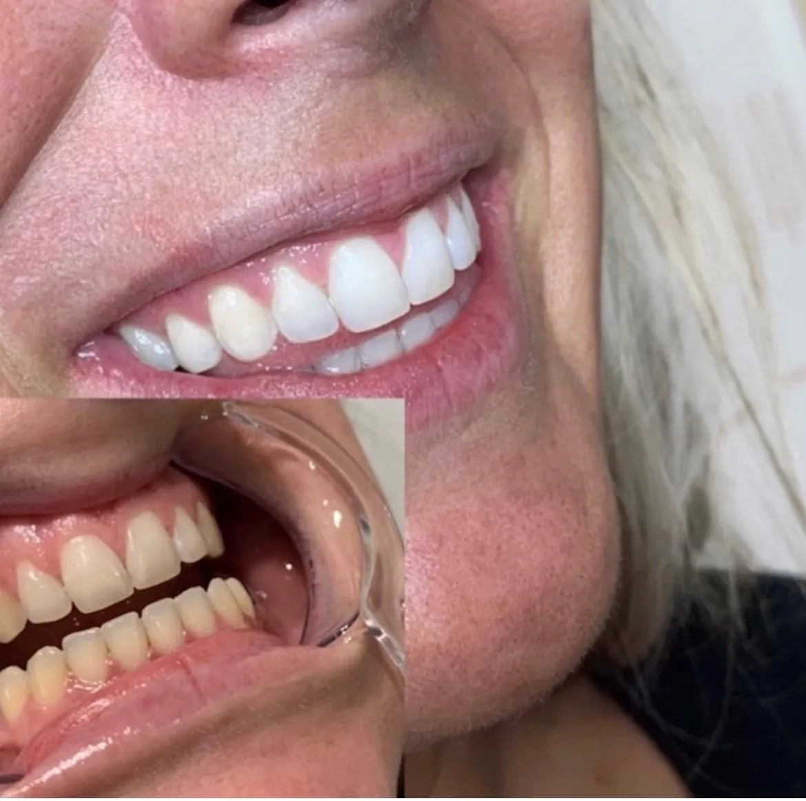 30372 long lasting teeth whitening