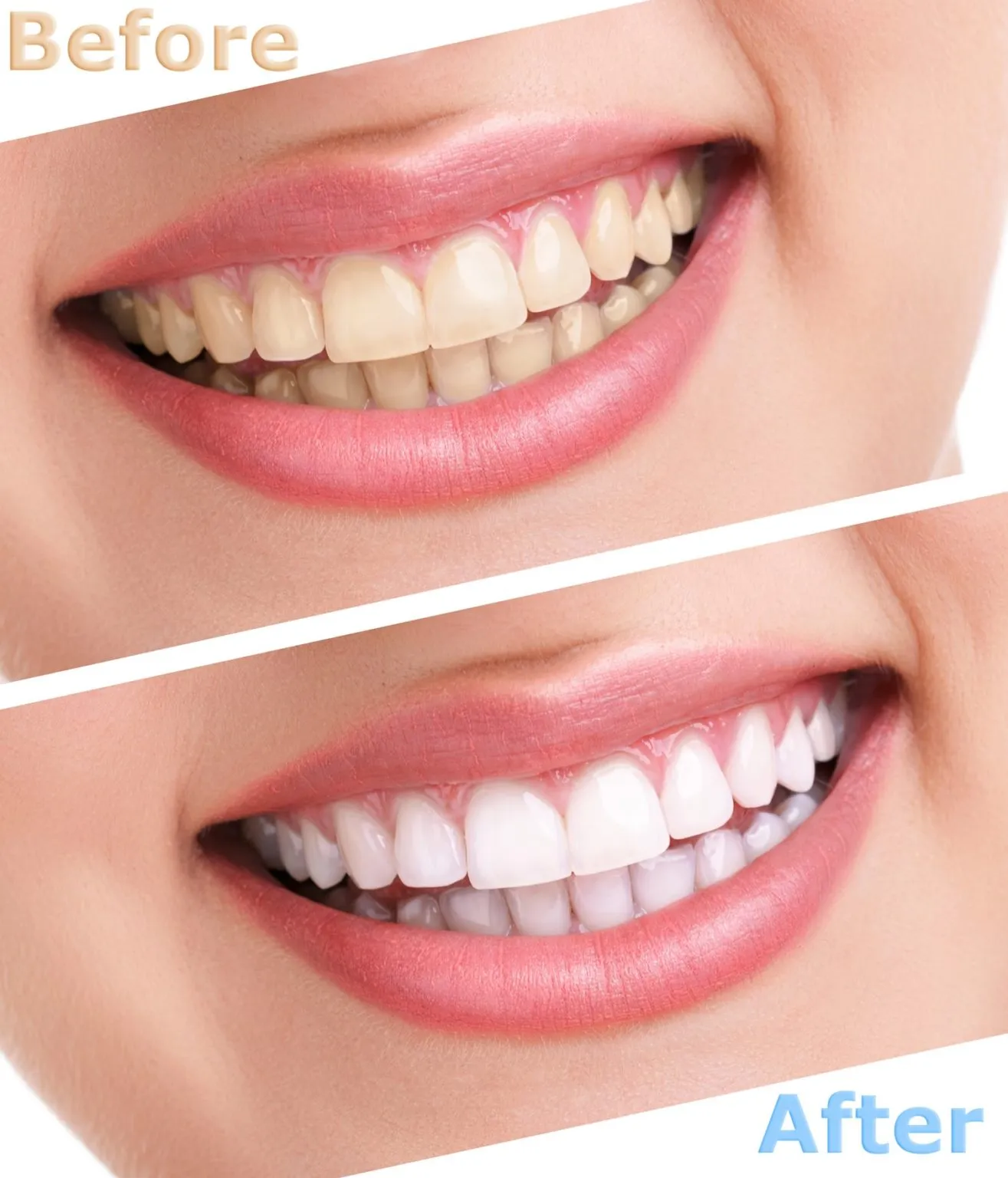 30373 teeth whitening bonding aftercare