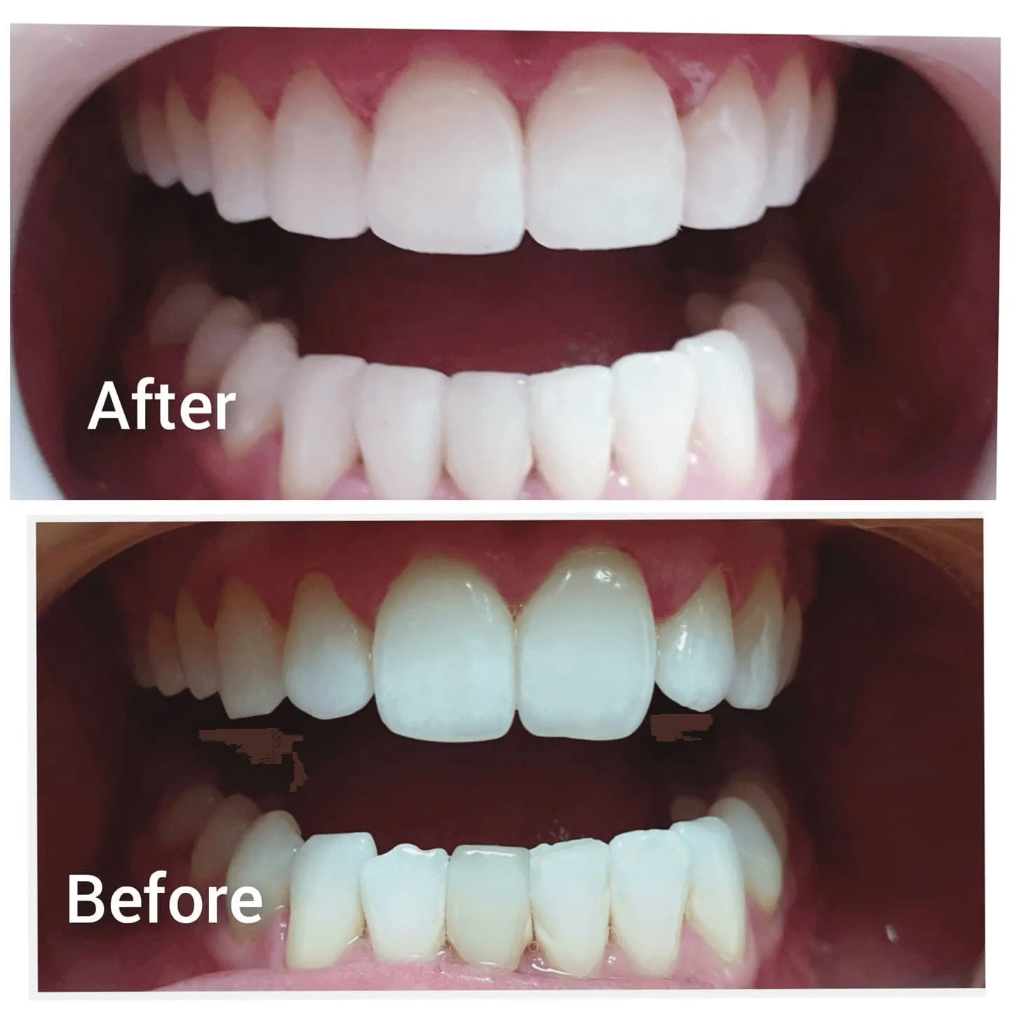 30373 teeth whitening bonding before after