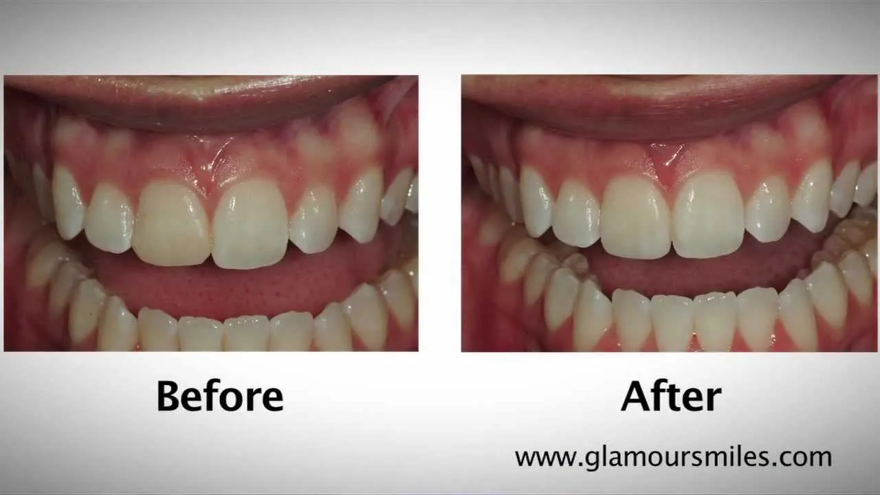 30373 teeth whitening bonding consultation