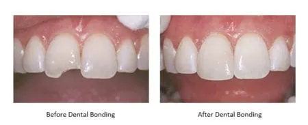/img/30373-teeth-whitening-bonding-smile.webp