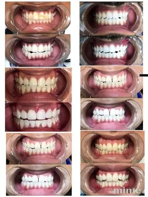 30375 at home teeth whitening