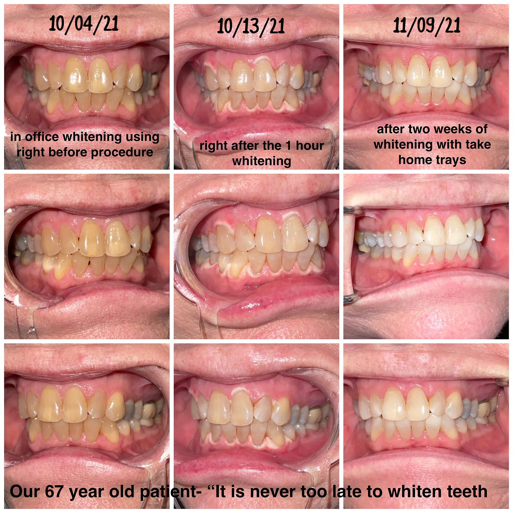 30375 professional teeth whitening