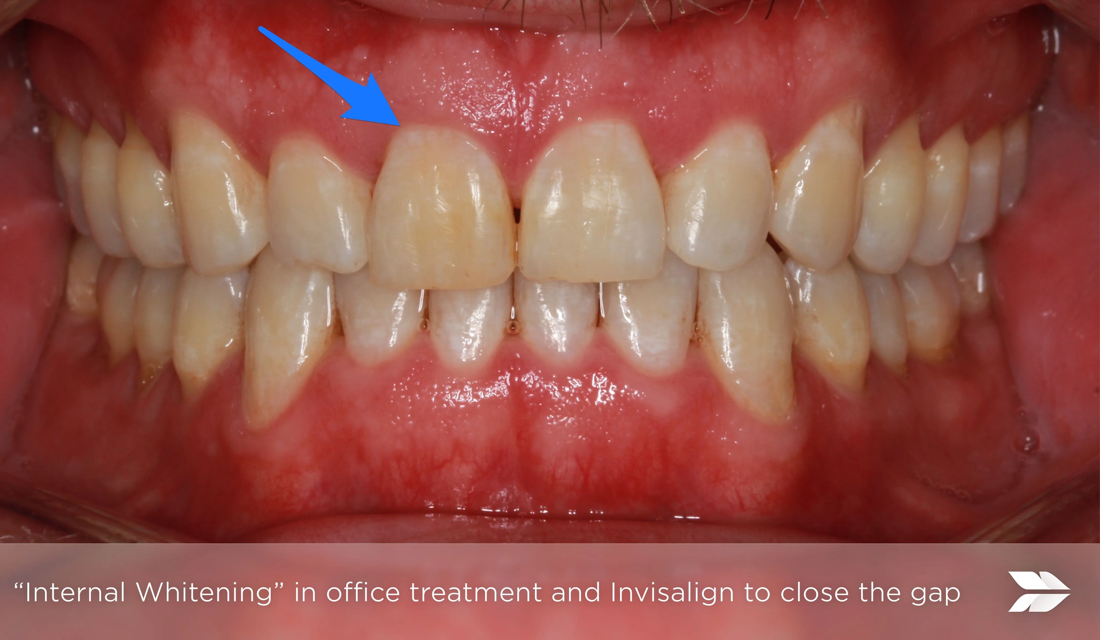 30375 teeth enamel structure