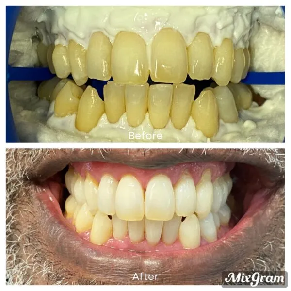 30375 teeth whitening cost