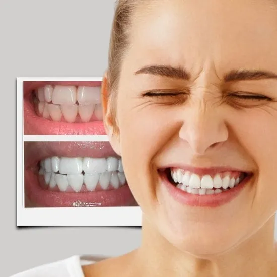 30378 invisalign aligners