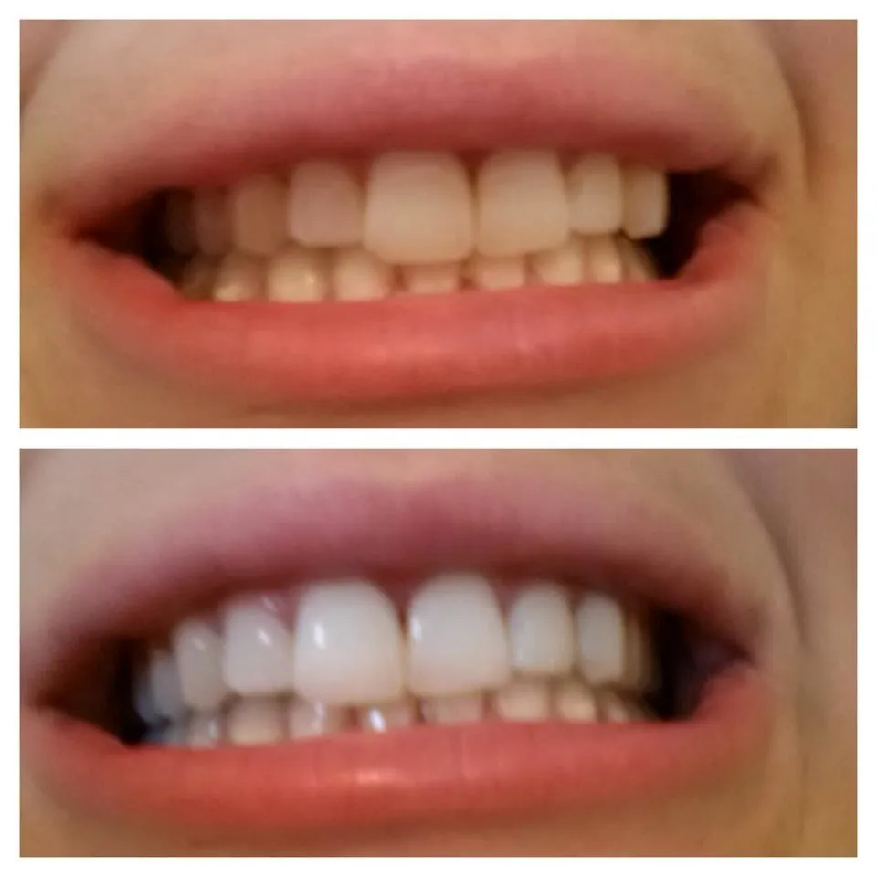30381 whitening before after