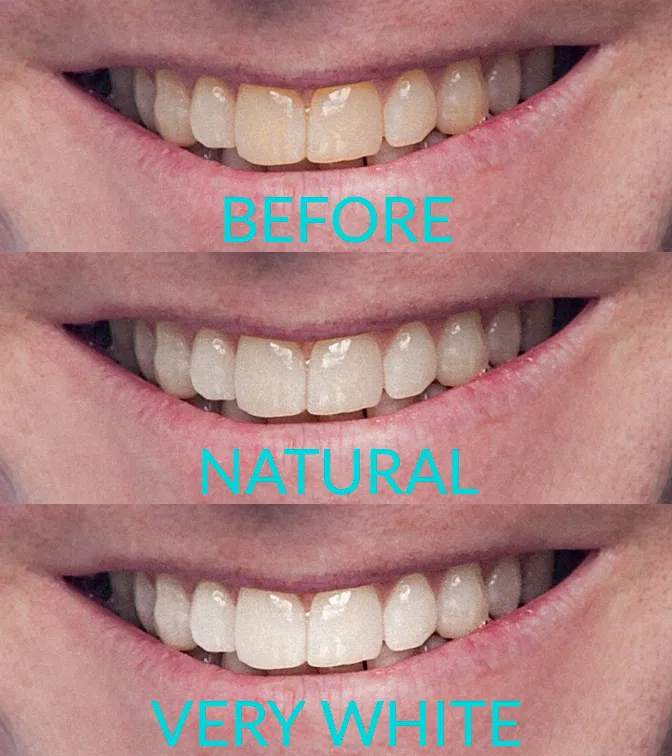 30389 photoshop teeth whitening before after