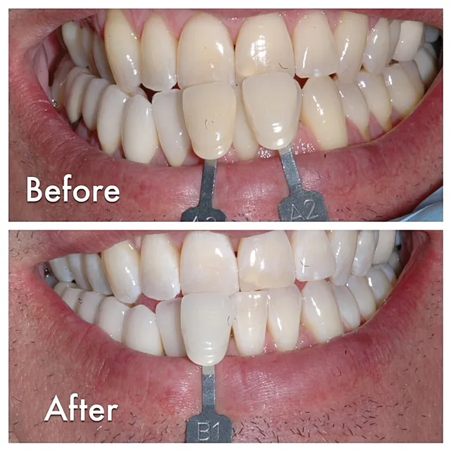 30392 laser teeth whitening after care