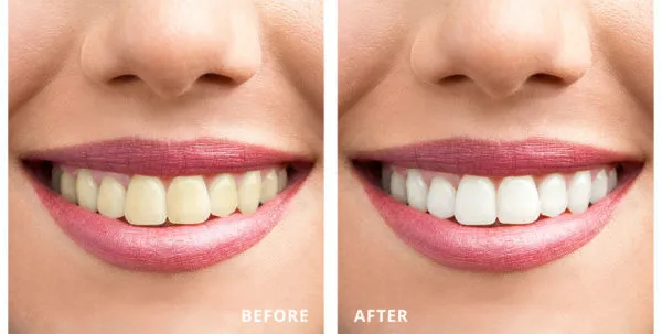 30392 laser teeth whitening before after 1