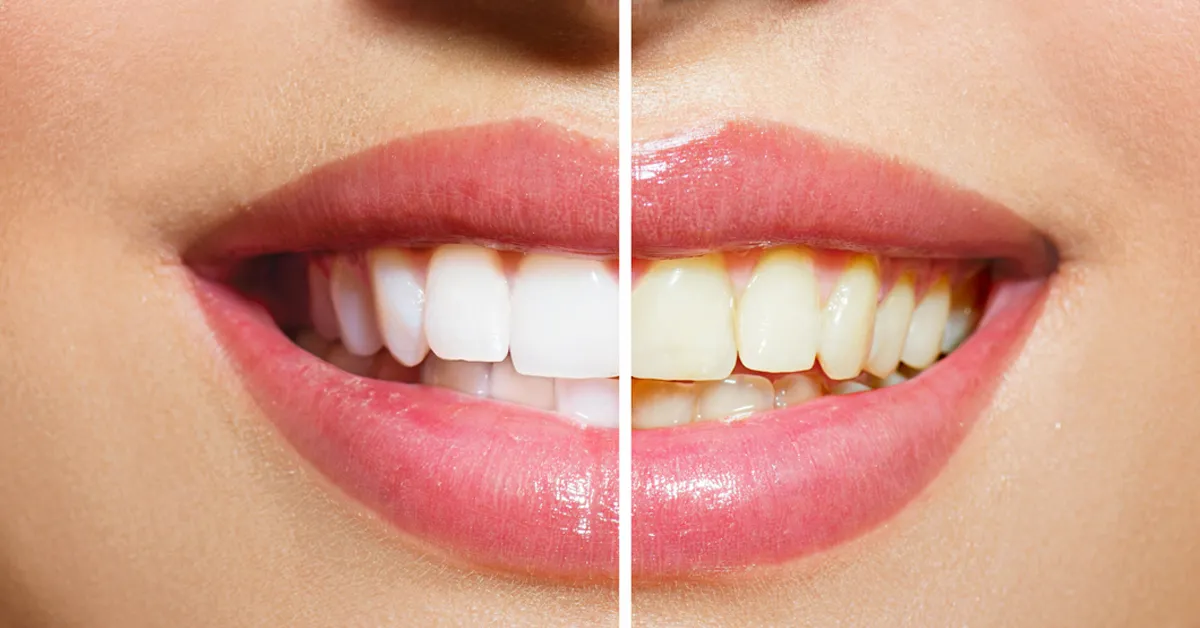 /img/30392-laser-teeth-whitening-cost.webp