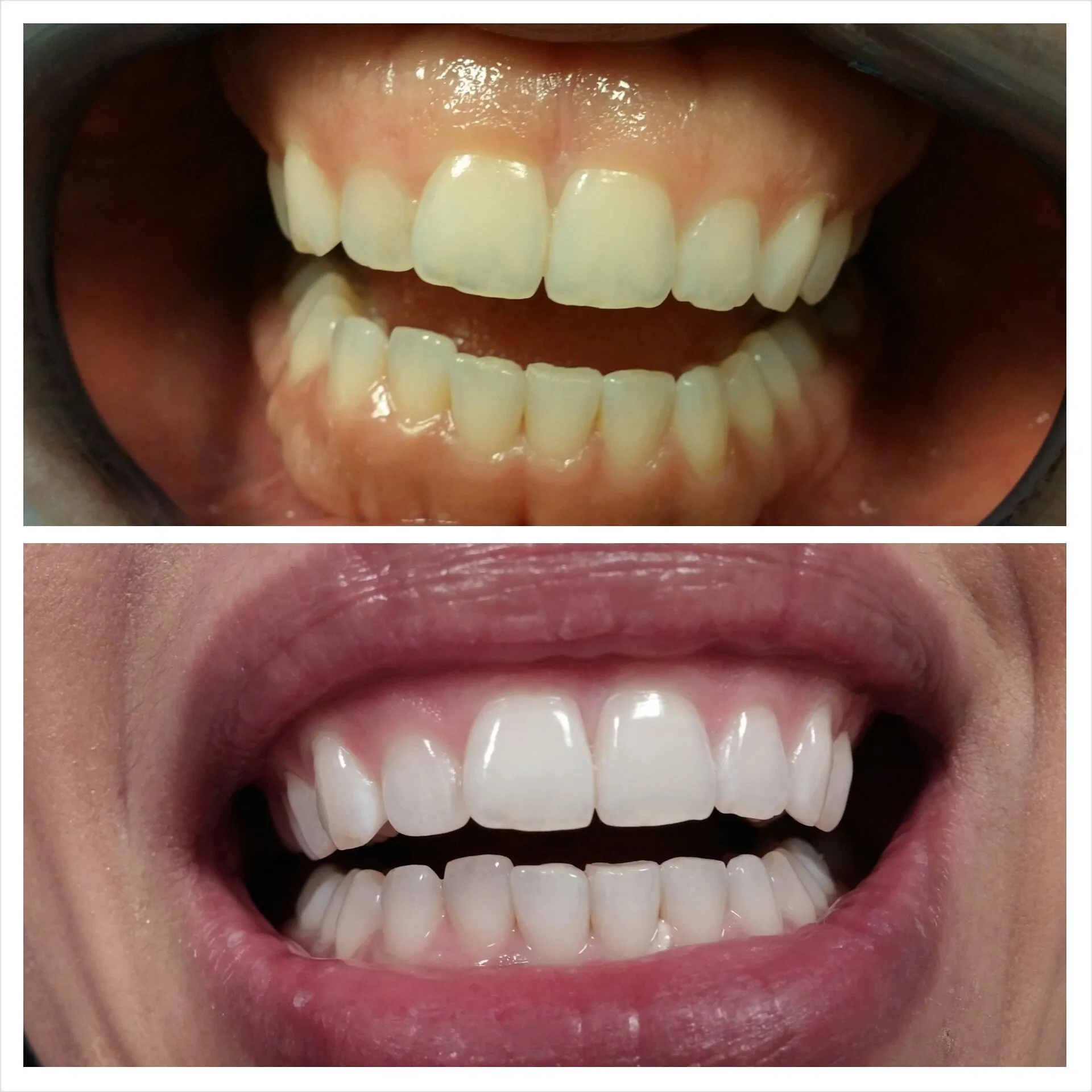 30392 laser teeth whitening process