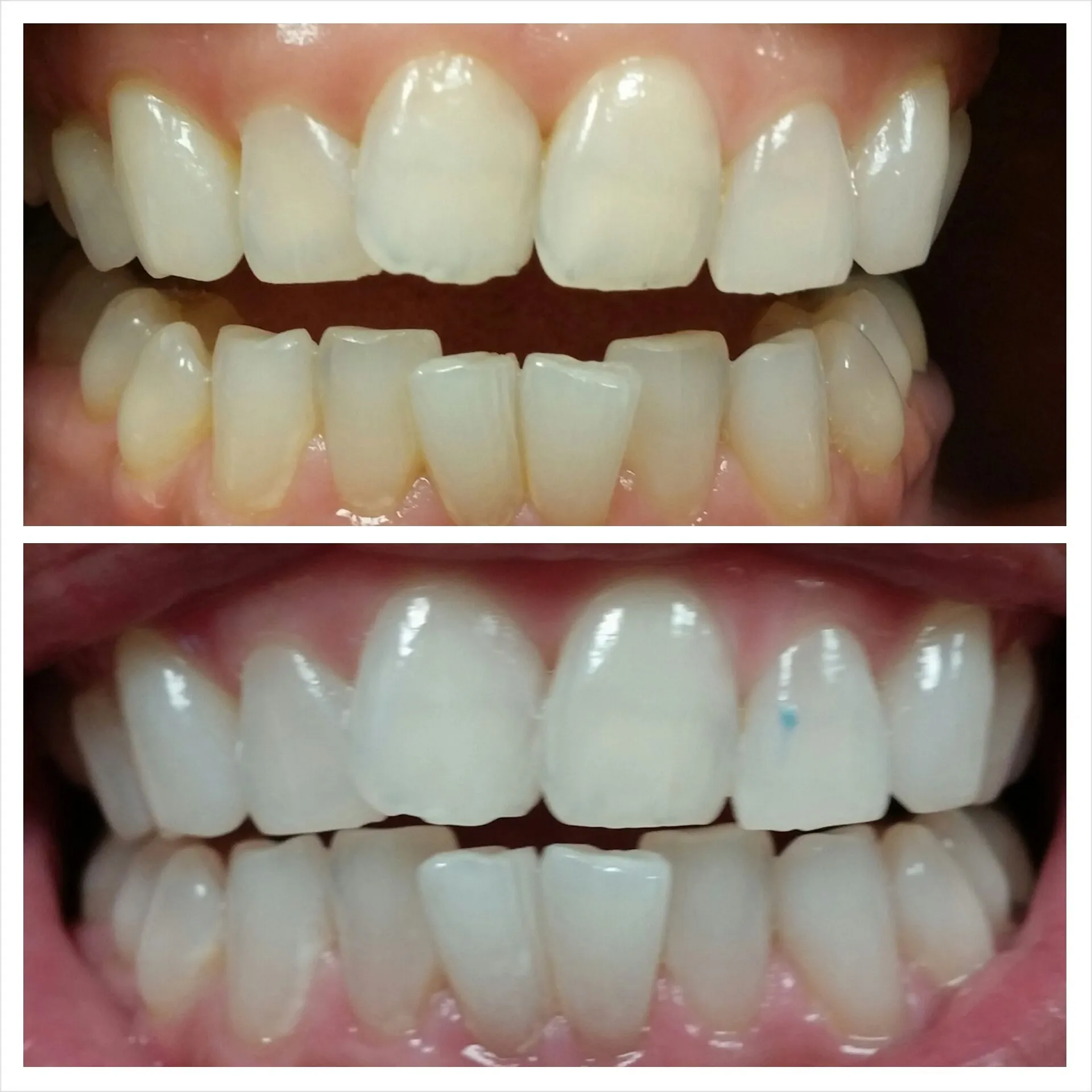 30392 laser teeth whitening results