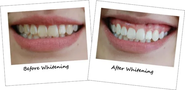 30392 laser teeth whitening shade assessment