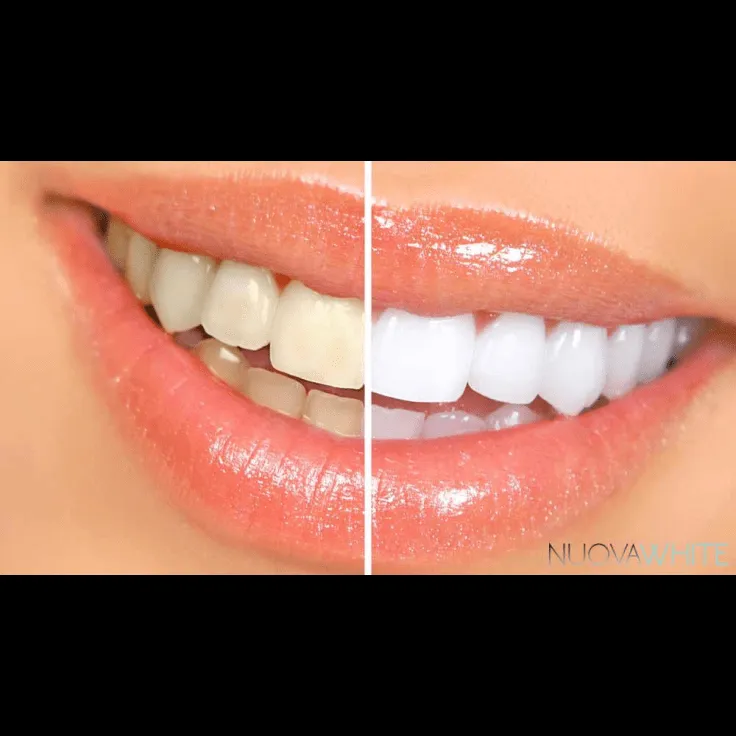 30393 nuovawhite kit components