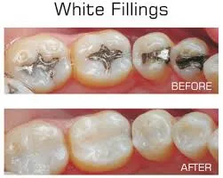 30397 types of dental fillings