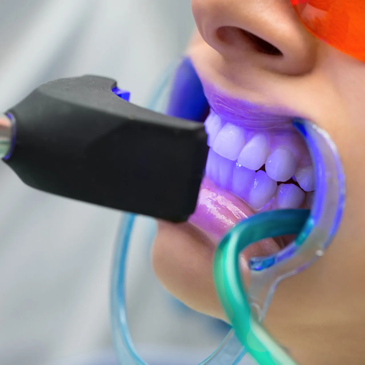 30403 professional teeth whitening liverpool