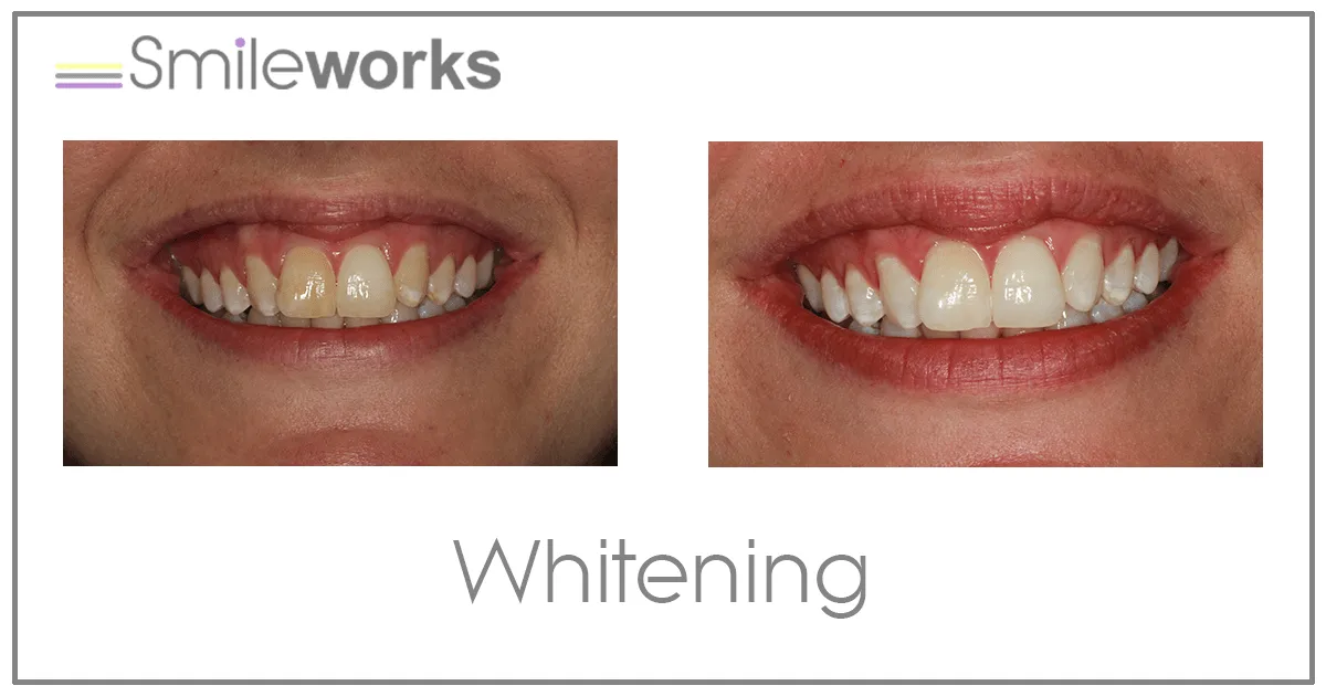 30403 teeth whitening cost liverpool