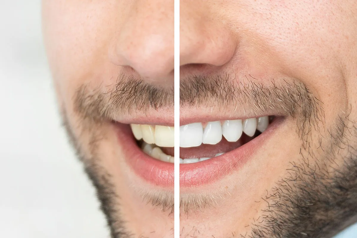 /img/30403-teeth-whitening-maintenance-liverpool.webp