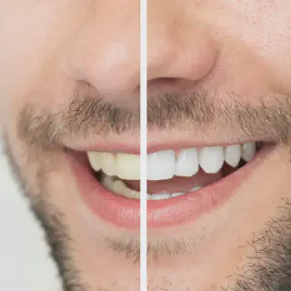 /img/30403-teeth-whitening-maintenance-liverpool.webp