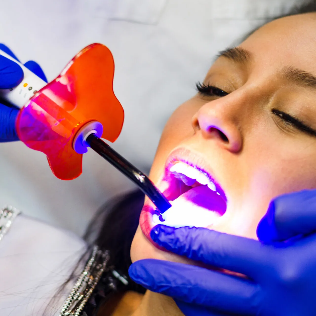 30403 teeth whitening procedure liverpool