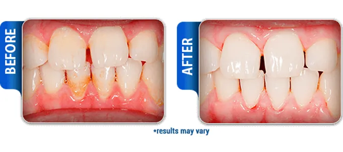 30408 radiance whitening pen brands