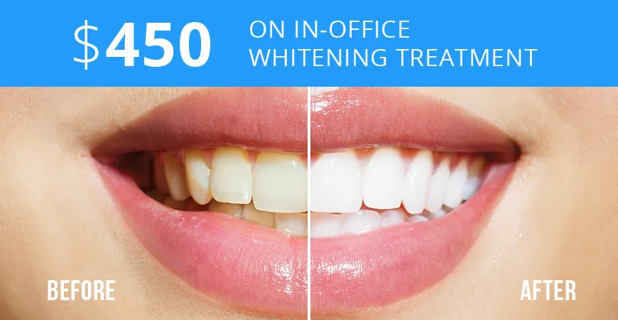 30409 teeth whitening options
