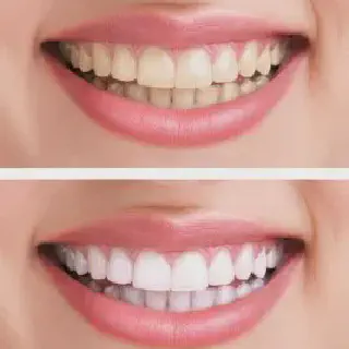 /img/30410-at-home-teeth-whitening.webp