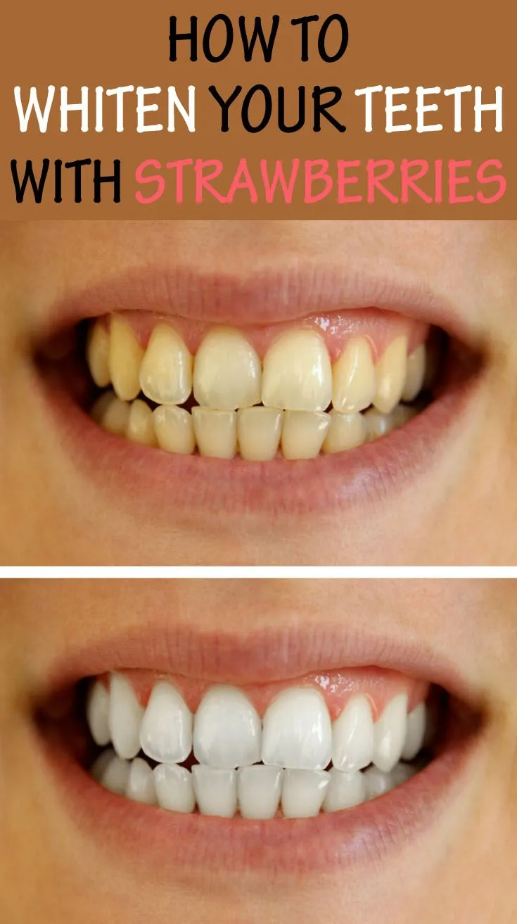 30417 strawberry teeth whitening method