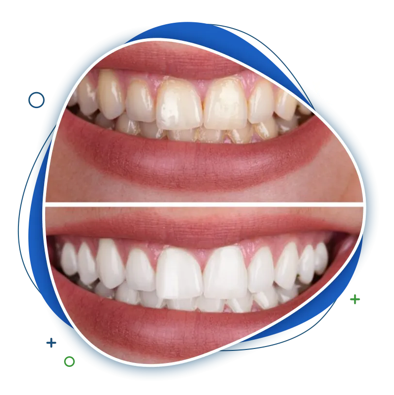 30418 take home tooth whitening kits