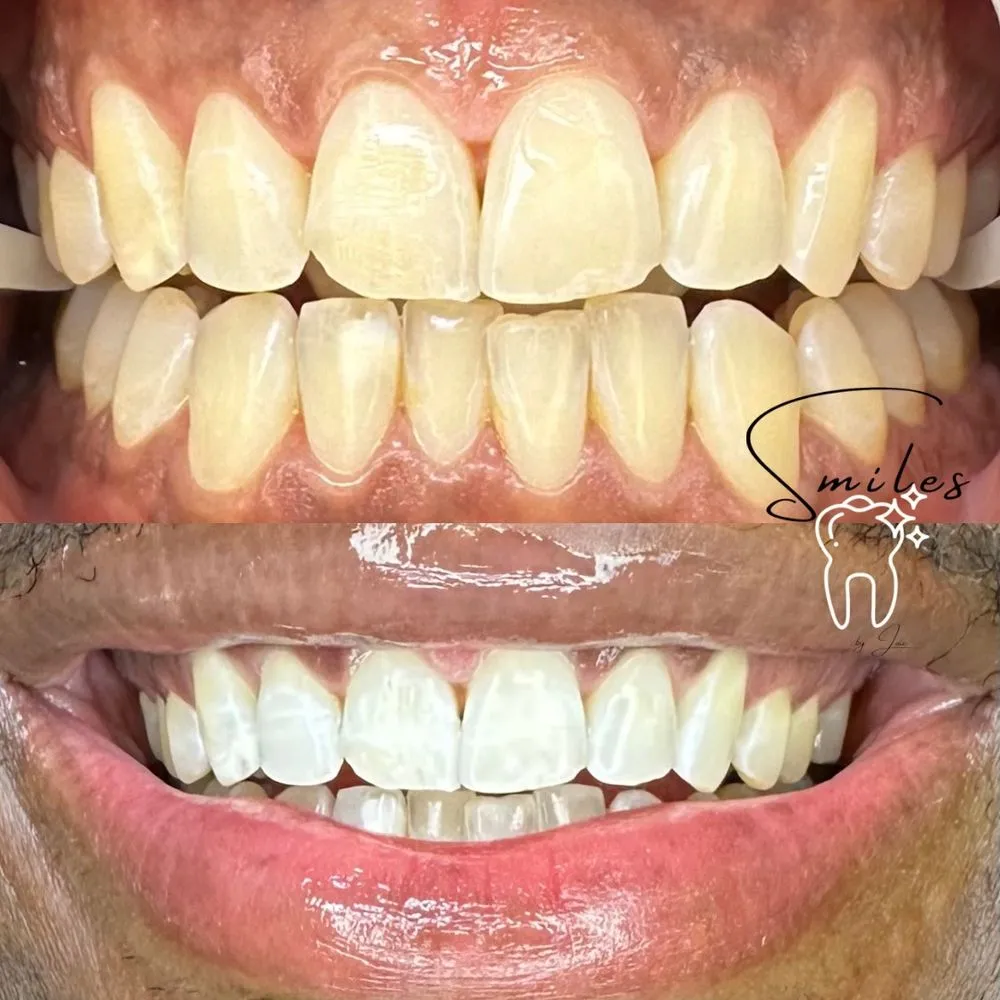 30418 teeth cleaning before whitening