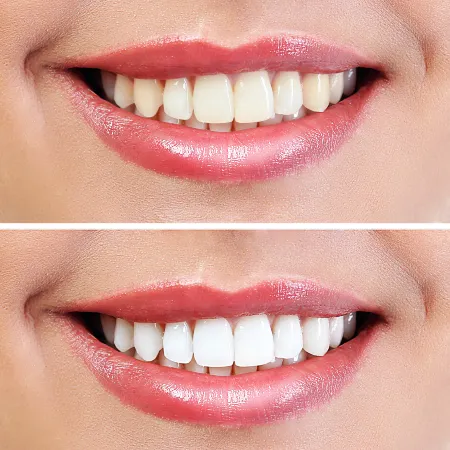 /img/30418-tooth-whitening-alternatives.webp