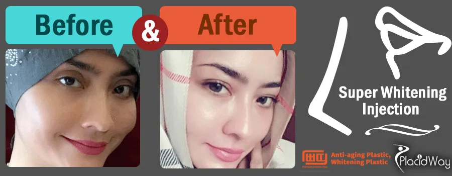 30422 skin whitening surgery cost factors