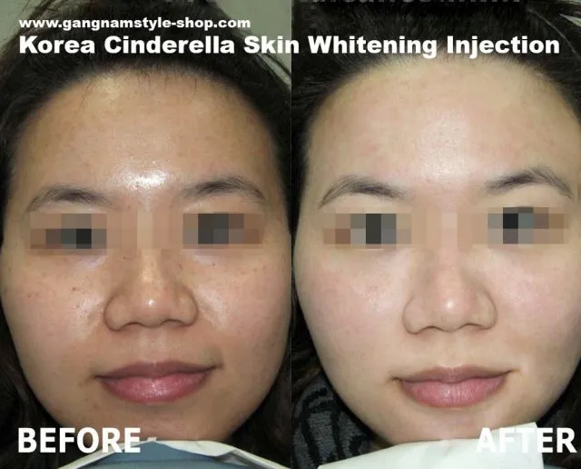 30422 skin whitening surgery procedures