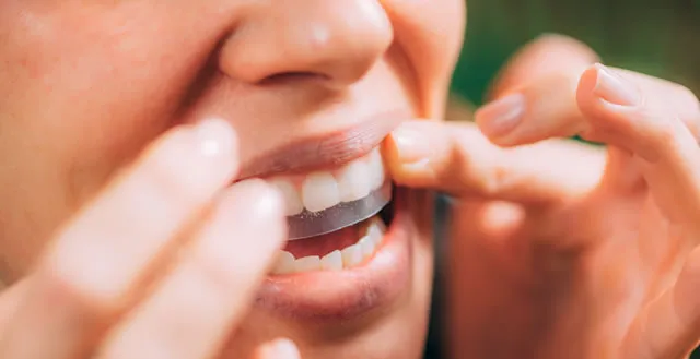 30425 at home teeth whitening kits