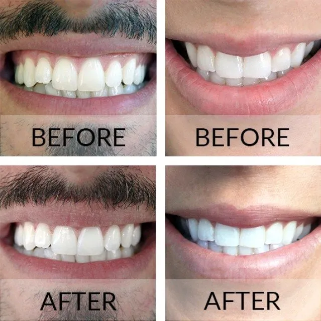 30425 in office teeth whitening