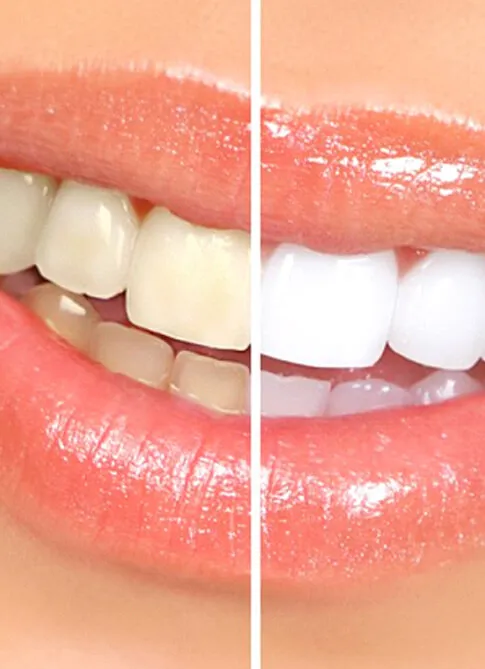 30426 teeth whitening MN