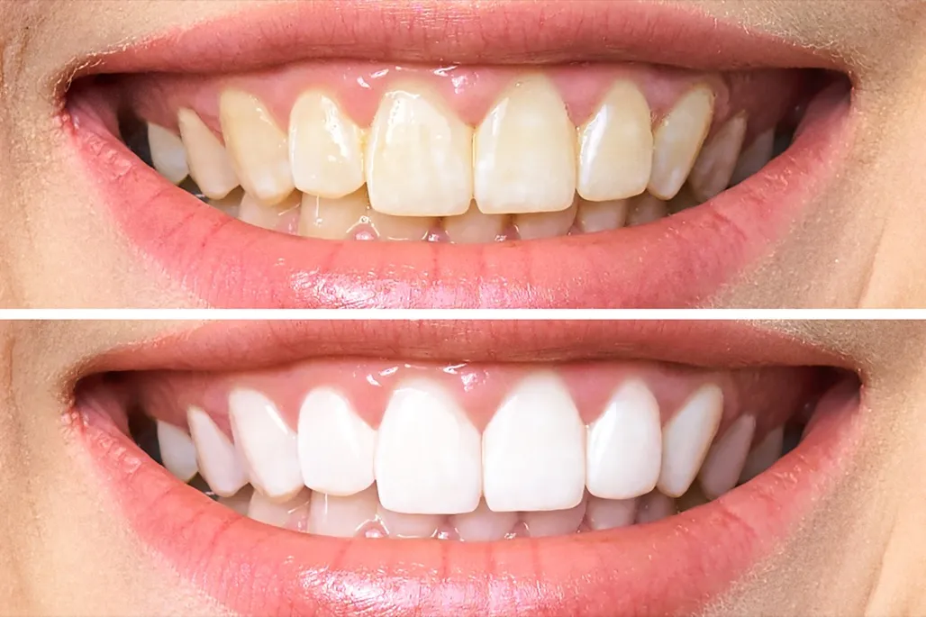 30426 whitening toothpaste