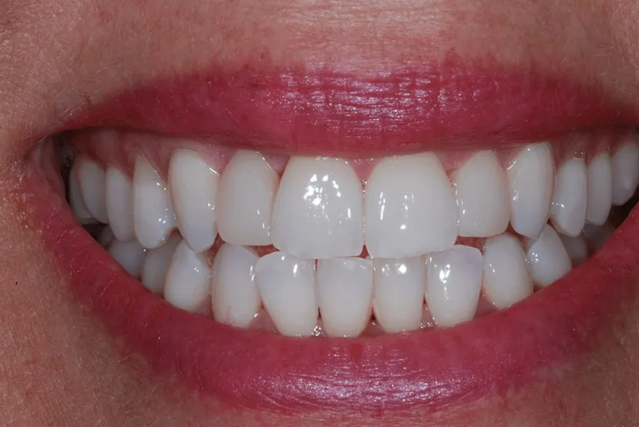 30428 wellington teeth whitening avoid stains