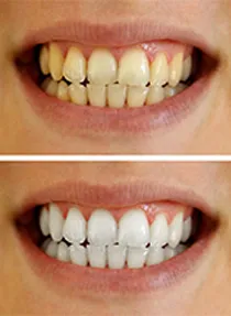 30428 wellington teeth whitening procedure