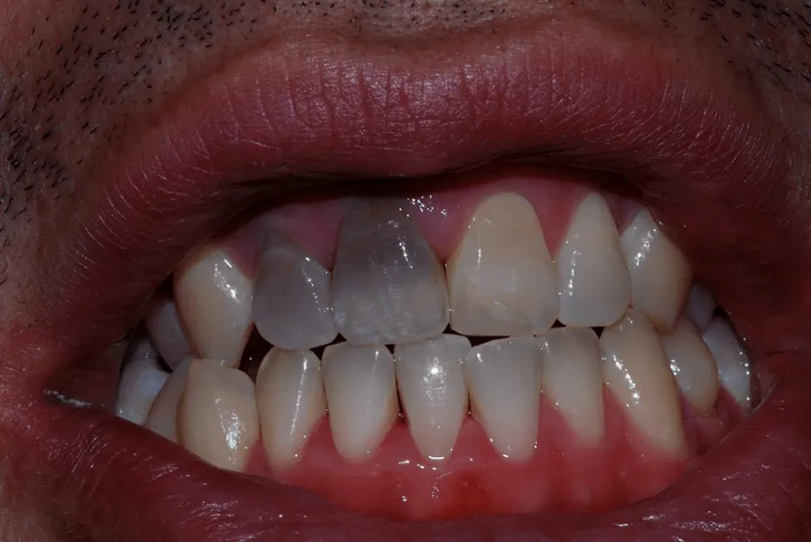 30428 wellington teeth whitening smiling woman