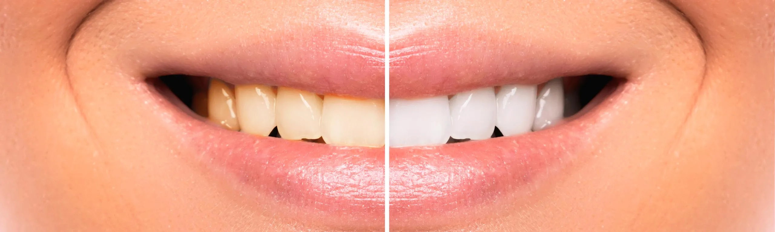 /img/30428-wellington-teeth-whitening-teeth-care.webp