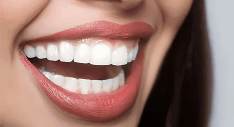 30429 home teeth whitening kit