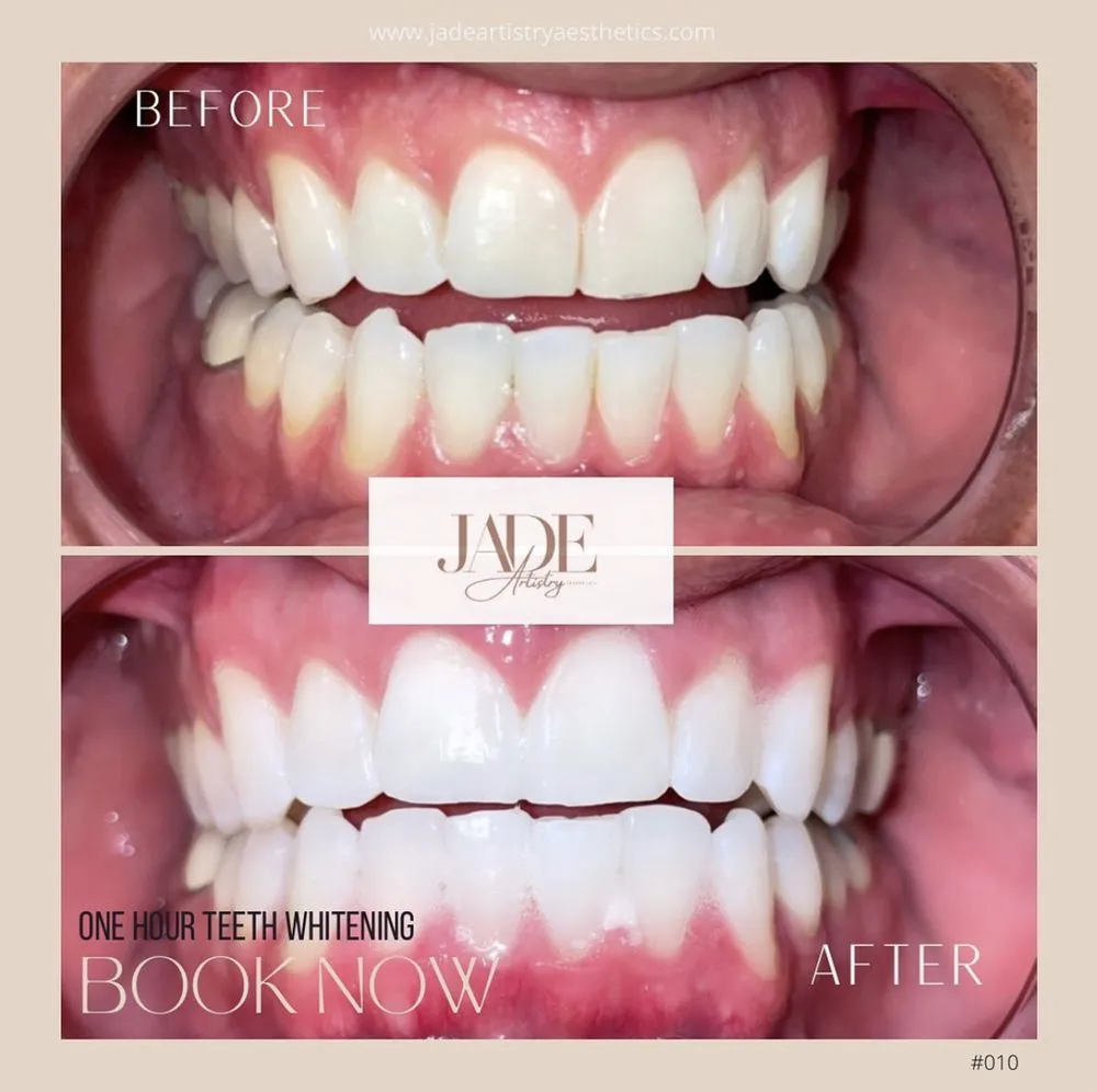 30429 laser teeth whitening